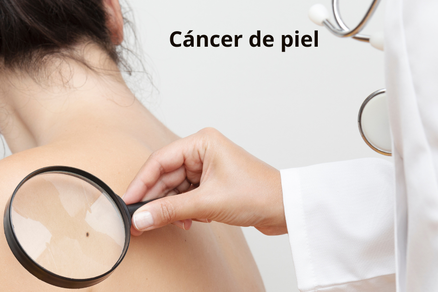 Cáncer de piel